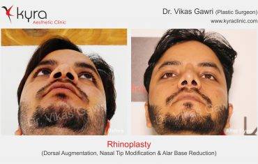 Rhinoplasty
