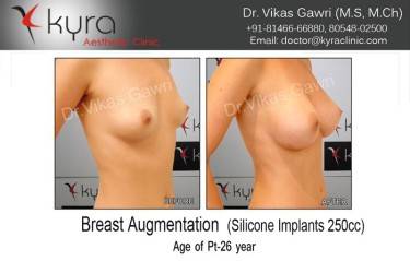 BREAST IMPLANTS
