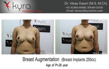 BREAST IMPLANTS