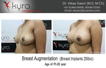 BREAST IMPLANTS