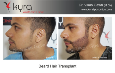 Beard Hair Transplant