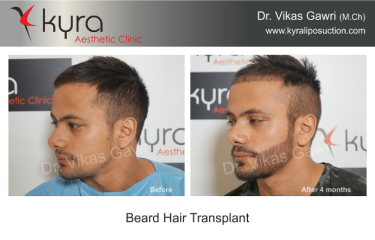 Beard Hair Transplant