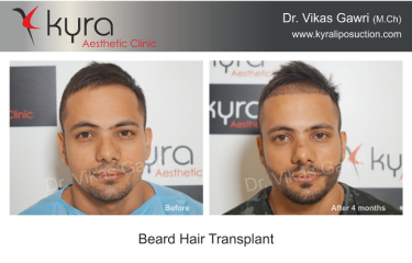 Beard Hair Transplant