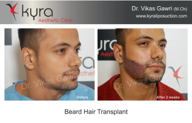 Beard Hair Transplant