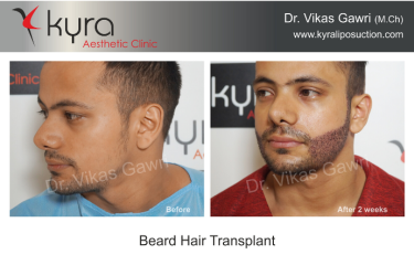 Beard Hair Transplant