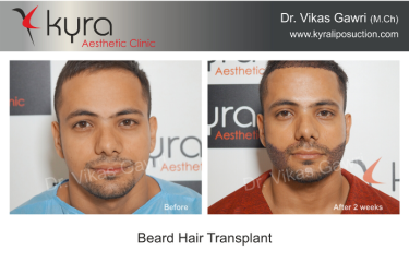 Beard Hair Transplant