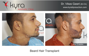 Beard Hair Transplant
