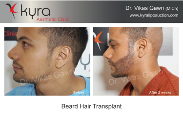 Beard Hair Transplant
