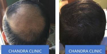Hair Transplant Treatment