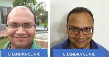 Hair Transplant Treatment