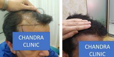 Hair Transplant Treatment