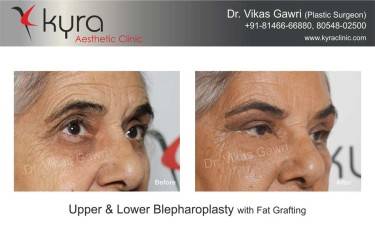 BLEPHAROPLASTY