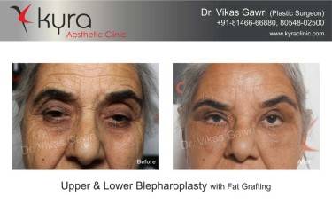 BLEPHAROPLASTY