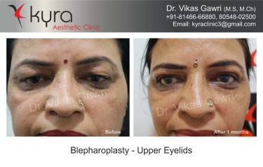 BLEPHAROPLASTY