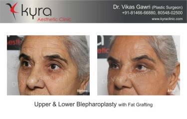 BLEPHAROPLASTY