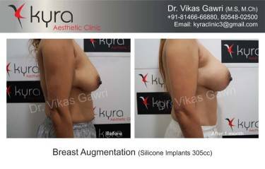 BREAST IMPLANTS
