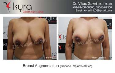 BREAST IMPLANTS