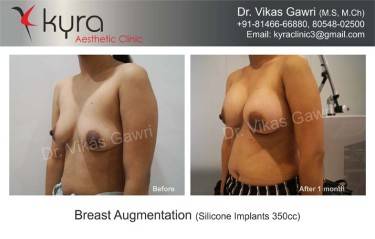 BREAST IMPLANTS