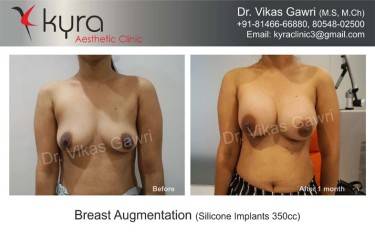BREAST IMPLANTS