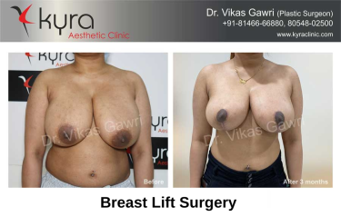BREAST REDUCTION