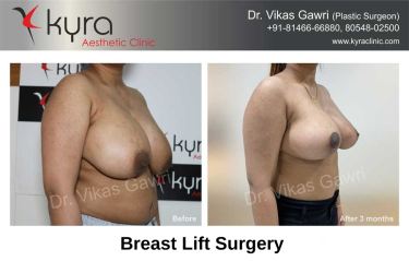 BREAST REDUCTION