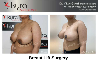 BREAST REDUCTION