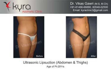 LIPOSUCTION FEMALE