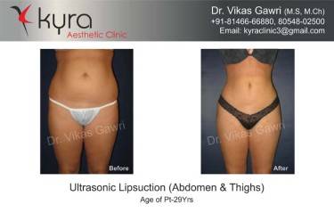 LIPOSUCTION FEMALE