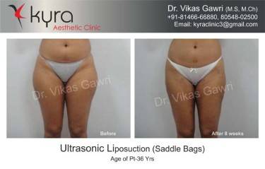 LIPOSUCTION FEMALE