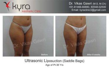 LIPOSUCTION FEMALE