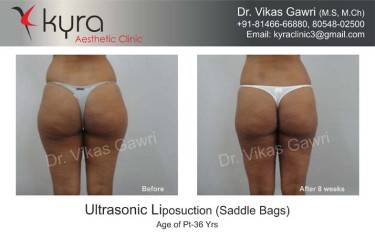 LIPOSUCTION FEMALE