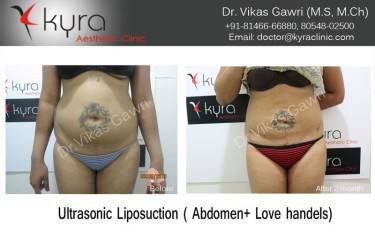 LIPOSUCTION FEMALE