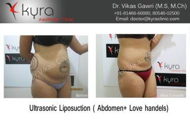 LIPOSUCTION FEMALE