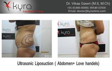 LIPOSUCTION FEMALE