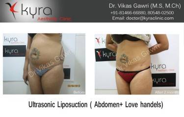 LIPOSUCTION FEMALE