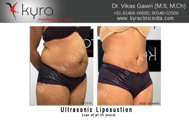 LIPOSUCTION FEMALE