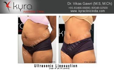 LIPOSUCTION FEMALE