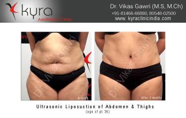 LIPOSUCTION FEMALE