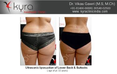 LIPOSUCTION FEMALE
