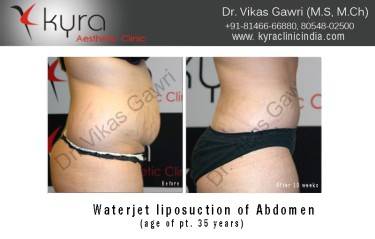 LIPOSUCTION FEMALE