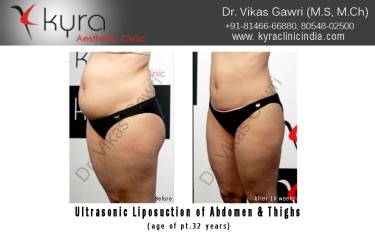 LIPOSUCTION FEMALE