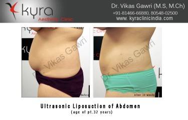 LIPOSUCTION FEMALE