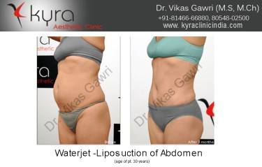 LIPOSUCTION FEMALE