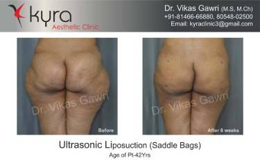 LIPOSUCTION FEMALE