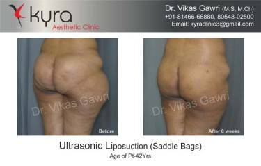 LIPOSUCTION FEMALE