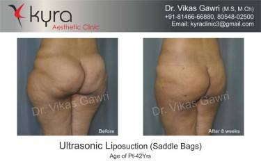 LIPOSUCTION FEMALE