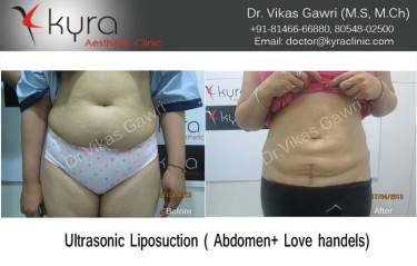LIPOSUCTION FEMALE