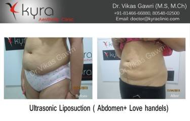 LIPOSUCTION FEMALE