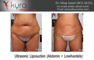 LIPOSUCTION FEMALE