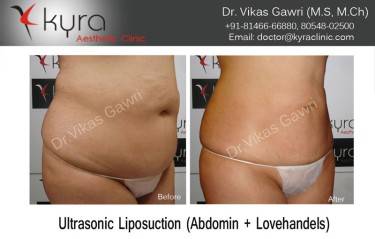 LIPOSUCTION FEMALE